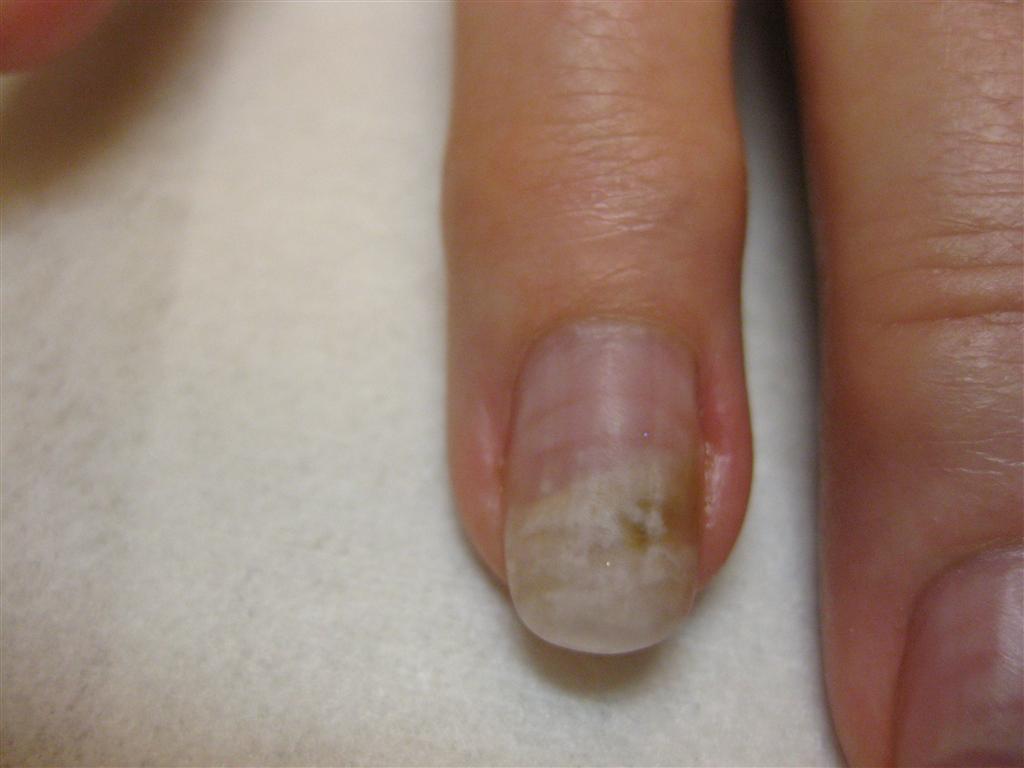 Gel Nail Fungus Pictures Nail Ftempo